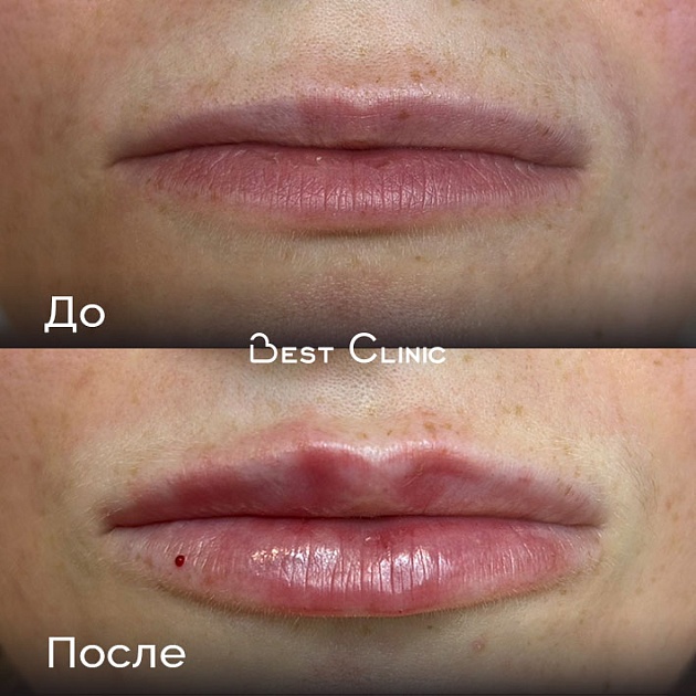 Контурная пластика губ (Belotero Lips Shape)
