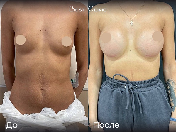 Увеличение молочных желез