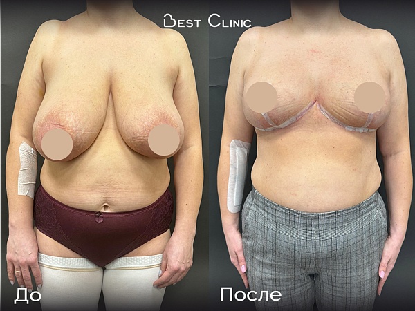 Редукционная маммопластика