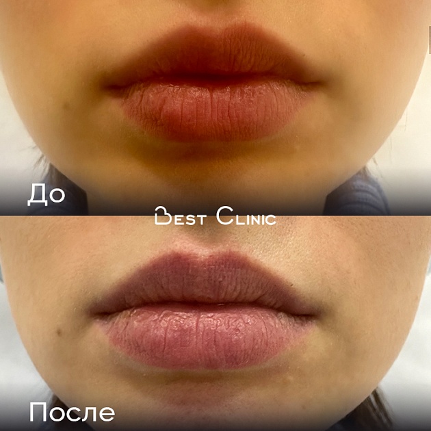 Коррекция подбородка препаратом гиалуроновой кислоты