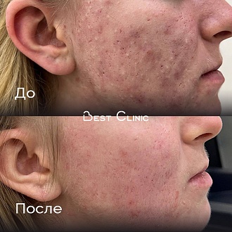 Лечение акне
