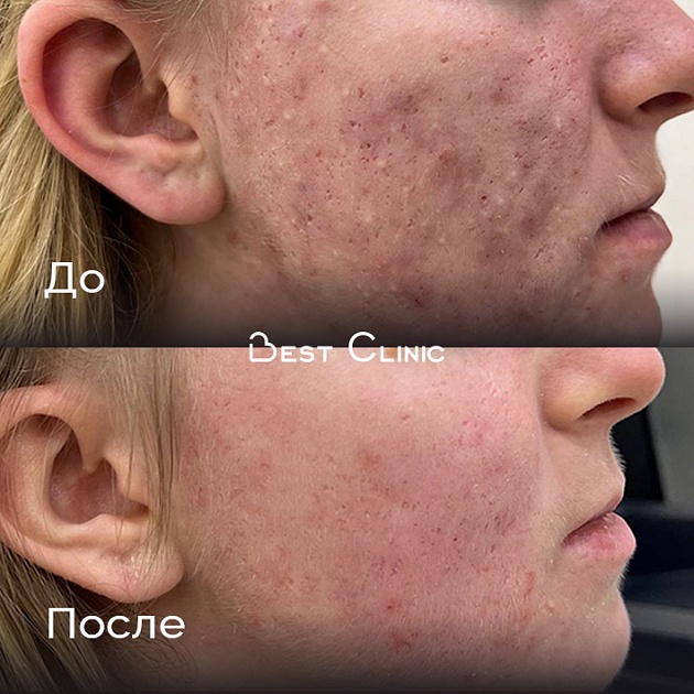 Лечение акне