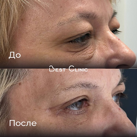 Верхняя и нижняя блефаропластика