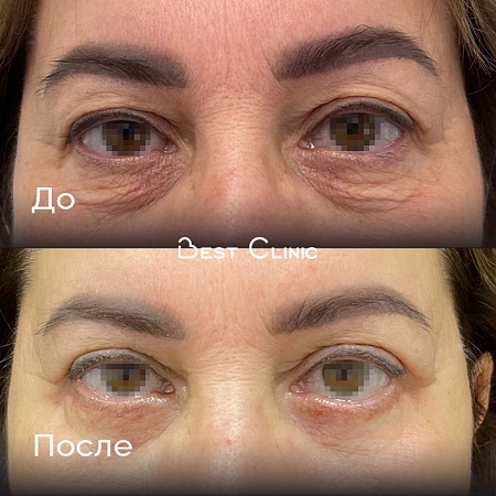 Нижняя блефаропластика