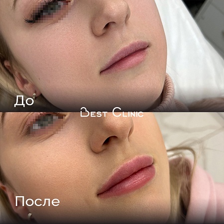 Увеличение губ