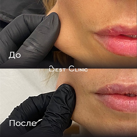 Работа с плотностью кожи препаратом полимолочной кислоты