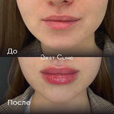 Увеличение губ