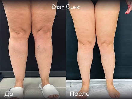 Липосакция голеней при липедеме нижних конечностей 2 степени