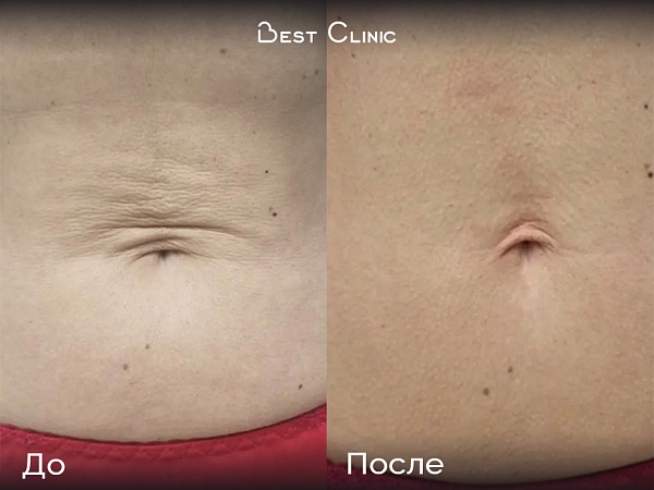 Ультразвуковой SMAS-лифтинг кожи живота