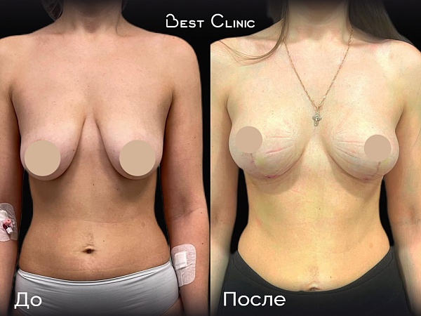 Т-инвертированная мастопексия