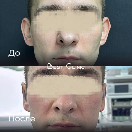 Отопластика