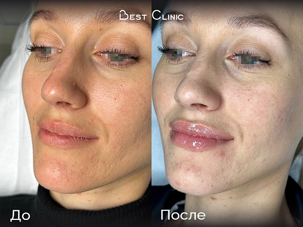 Увеличение губ