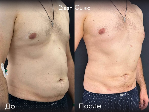 Липосакция живота и боков