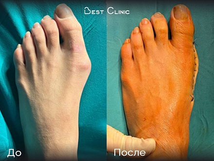 Реконструктивно-пластическая операция на переднем отделе стопы (Hallux Valgus)