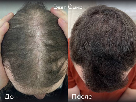 Лечение андрогенной алопеции