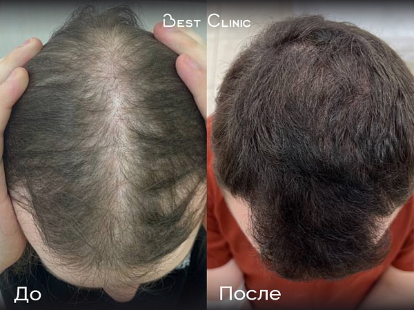 Лечение андрогенной алопеции