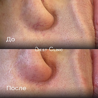 Удаление крупных сосудов в области носа