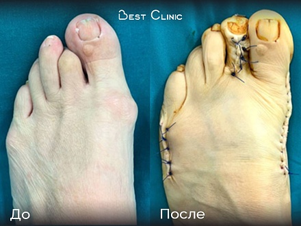 Реконструктивно-пластическая операция на переднем отделе стопы (Hallux Valgus)