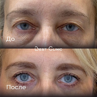 Верхняя и нижняя блефаропластика