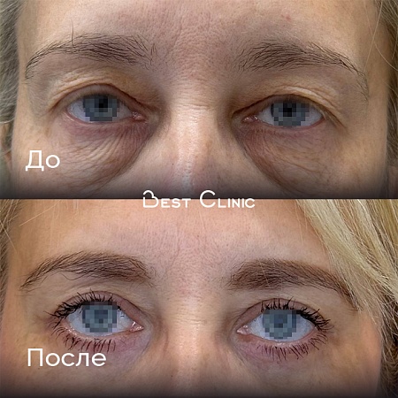 Верхняя и нижняя блефаропластика