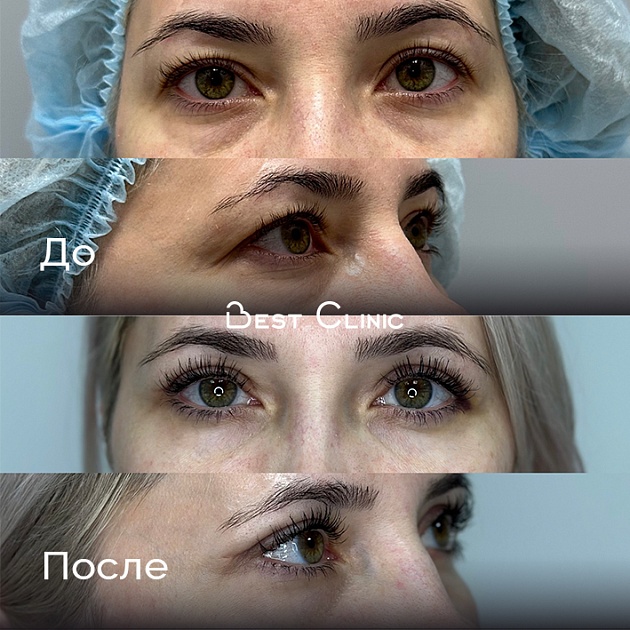 Блефаропластика 