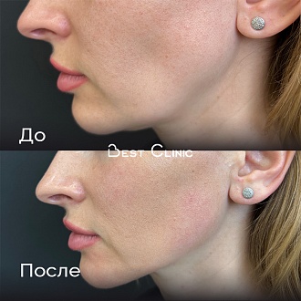 Игольчатый RF-лифтинг