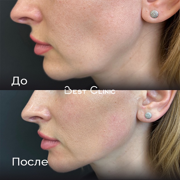 Игольчатый RF-лифтинг