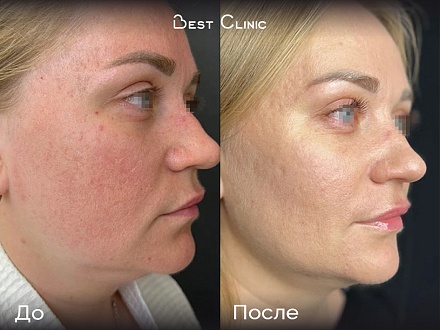 Игольчатый RF-лифтинг