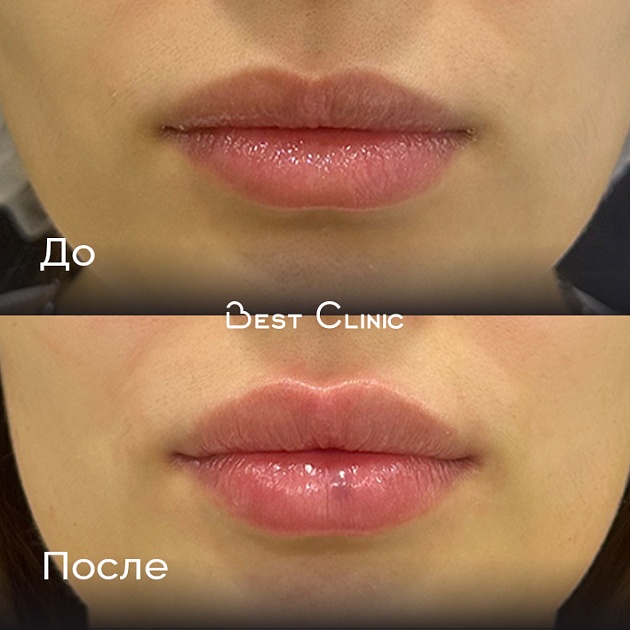 Контурная пластика губ препаратом гиалуроновой кислоты