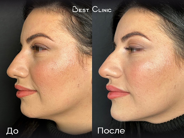 Аугментация подбородка