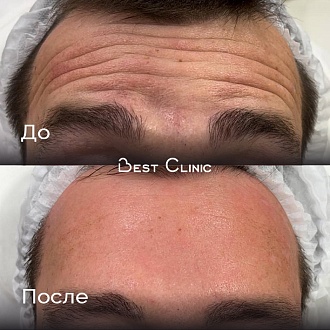 Ботулинотерапия