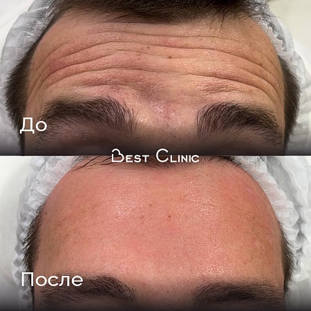 Ботулинотерапия