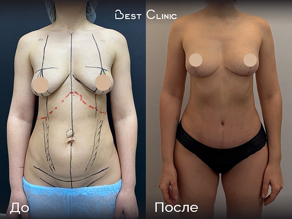 Липоабдоминопластика + мастопексия без имплантов