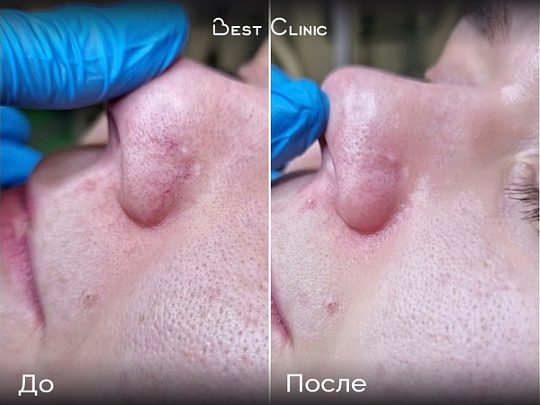 Лазерное удаление сосудов