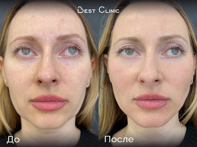 Контурная пластика средней трети лица и углов нижней челюсти