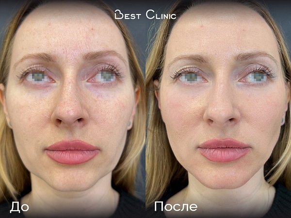 Контурная пластика средней трети лица и углов нижней челюсти