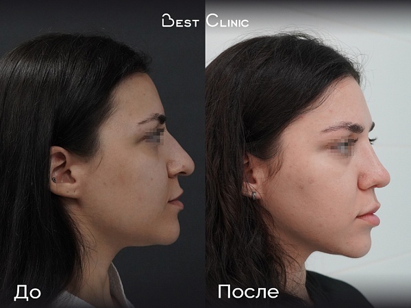 Риносептопластика