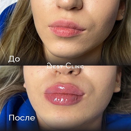 Увеличение губ