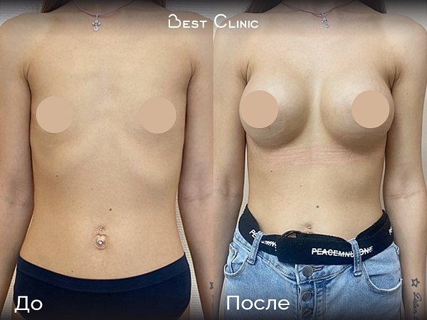 Увеличение груди