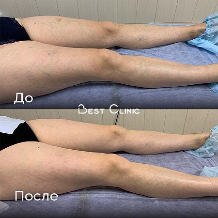 Склеротерапия ТАЭ