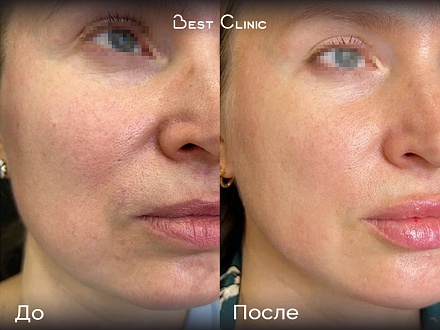 Игольчатый RF-лифтинг