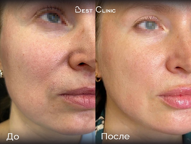 Игольчатый RF-лифтинг