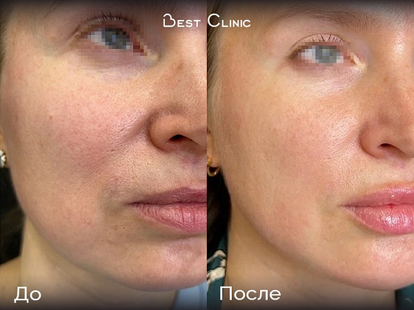 Игольчатый RF-лифтинг