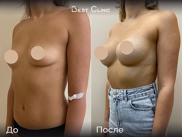 Увеличение груди