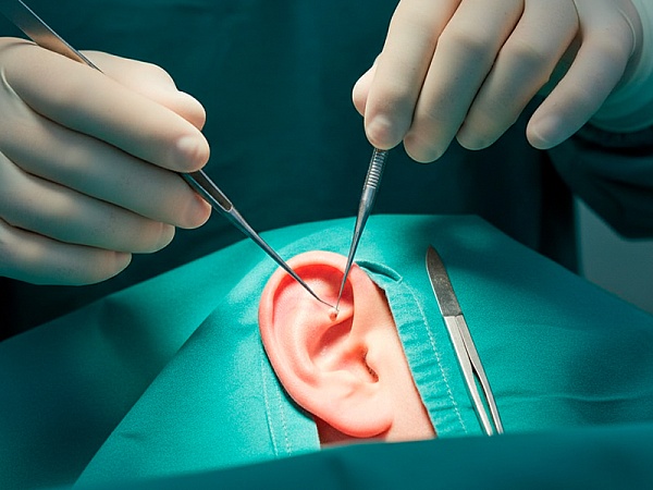 Отопластика