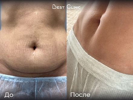 Липосакция, абдоминопластика, ушивание диастаза, липоскульптура