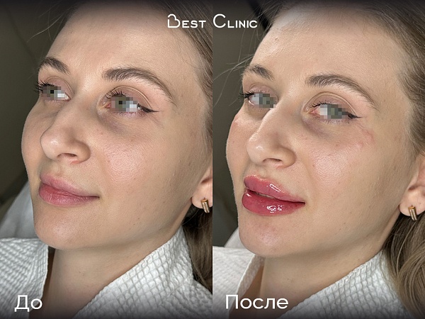 Увеличение губ