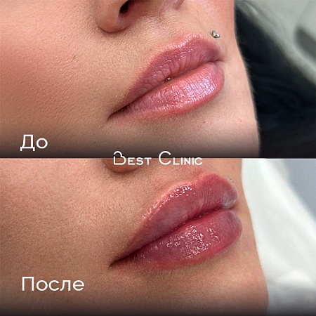 Увеличение губ