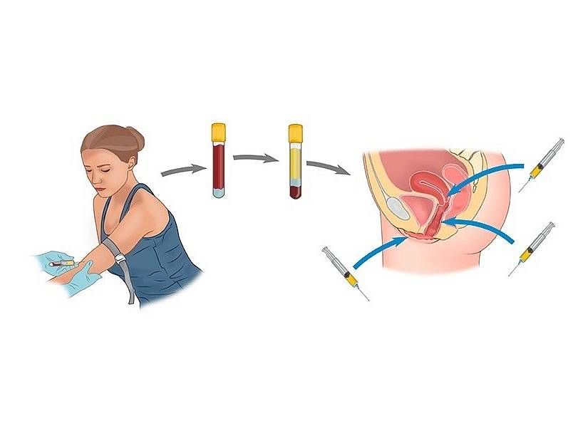 Основные этапы процедуры плазмотерапии в гинекологии: