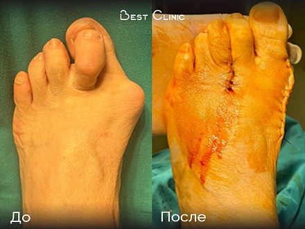 Реконструктивно-пластическая операция на передних отделах стопы (Hallux Valgus)
